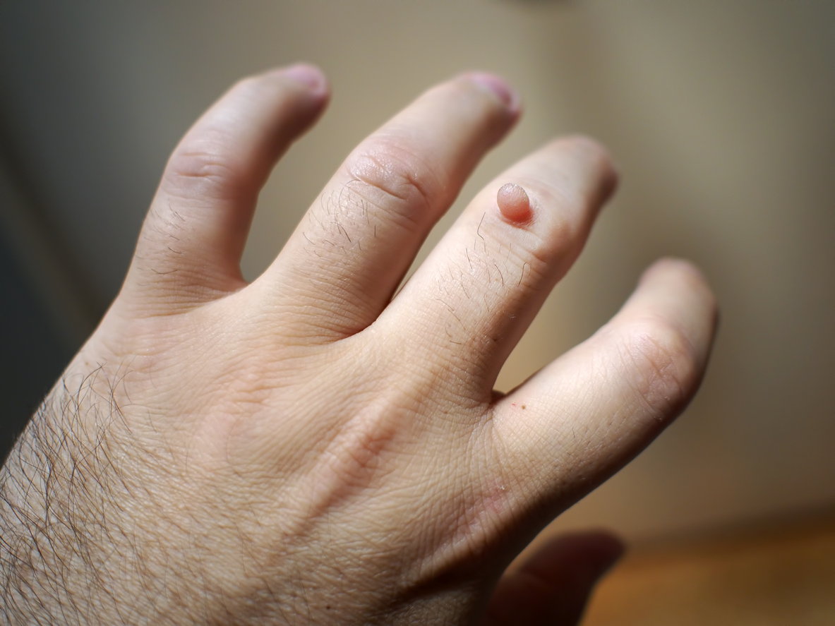 a wart on the finger