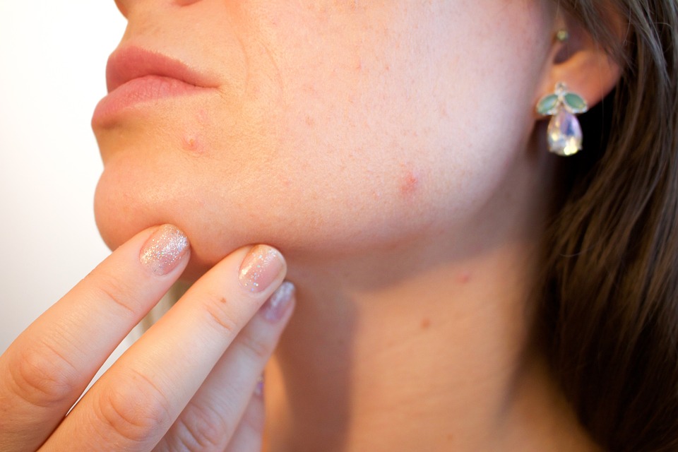acne are a common skin condition
